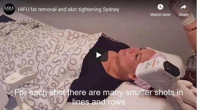 HIFU fat removal and skin tightening Sydney