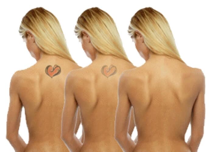 Painless laser tattoo removal Sydney best safe effective #1