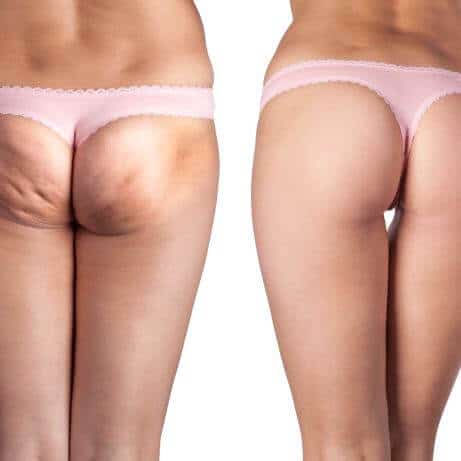 RF ultrasound cellulite removal therapy Sydney 1 best effect