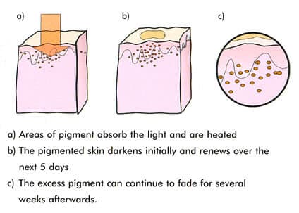 IPL laser pigmentation removal therapy Sydney #1 best clinic