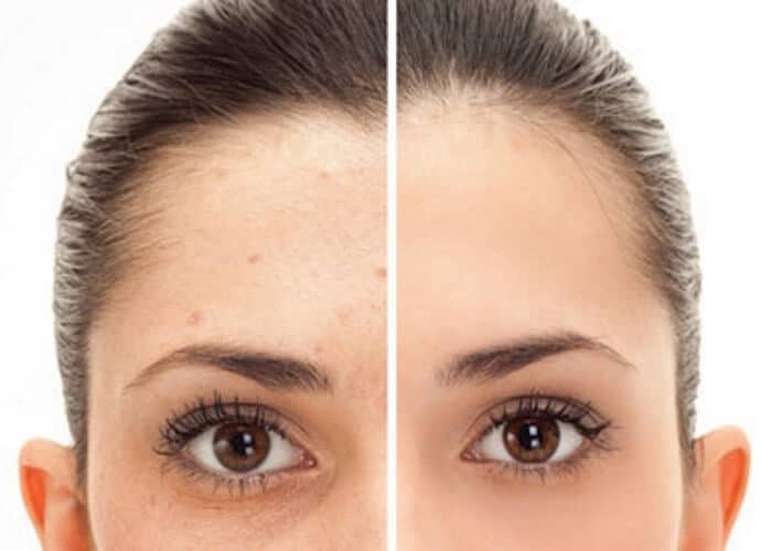 IPL laser pigmentation removal therapy Sydney 1 finest clinic