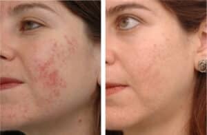 Remove acne scars Sydney Where to and how safe effective