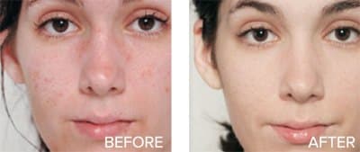  skin firming and toning acne removal age spot and sun spot removal