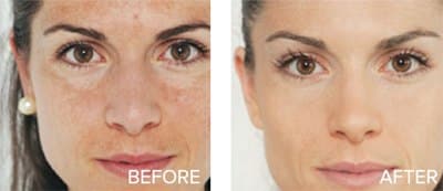 anti-wrinkle niacinamide wrinkle removal