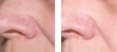 dark circles and puffy eyes rashes spider vein removal