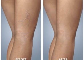 IPL laser red spider vein removal Sydney better #1 safe