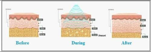 Ultrasonic fat cellulite treatment Sydney reduction