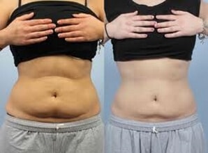 Weight loss from fat removal Sydney EMS freezing treatment
