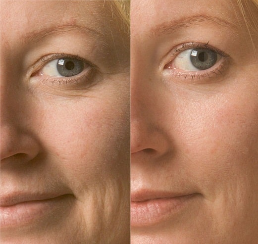 Anti wrinkle removal treatment Sydney