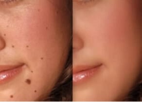 Safe effective mole blemish removal Sydney #1 best how where