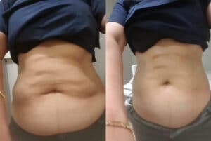 Fat freezing vs weight loss in Sydney Top 10 benefits of fat freezing in Sydney