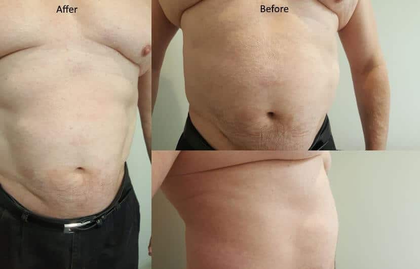 Top 10 benefits laser liposuction vs weight loss Sydney