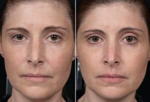 anti aging wrinkle remove face lift Mosman #1 best Thermagie skin tightening