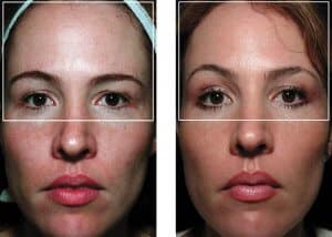 anti aging wrinkle remove face lift Roseville #1 Thermagie skin tightening