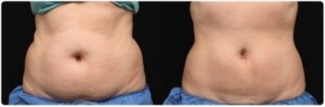 Fat freezing cryolipolysis lipo Hunters Hill cool sculpting cavitation laser liposuction