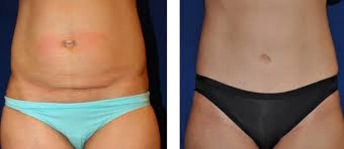 Fat freezing cryolipolysis lipo North Sydney cool sculpting cavitation laser liposuction