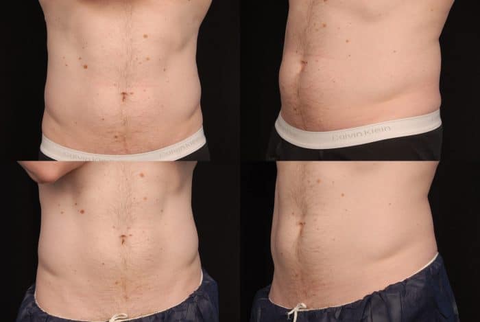 Fat freezing cryolipolysis lipo Darlinghurst cool sculpting cavitation laser liposuction