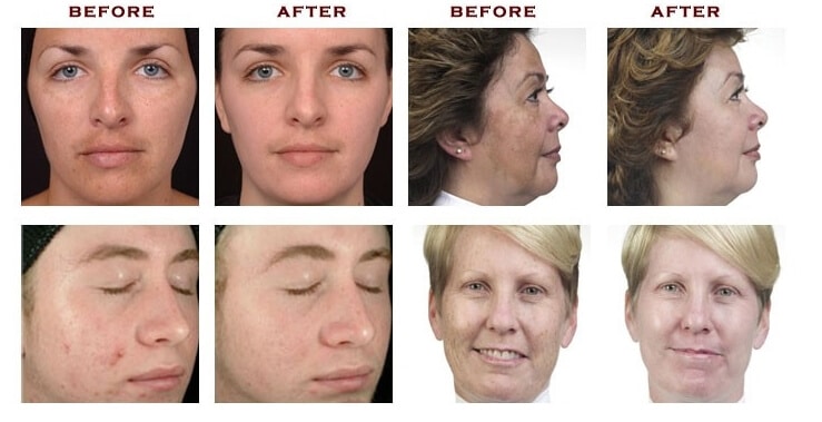 hydro diamond oxygen microdermabrasion Sydney #1 best effect