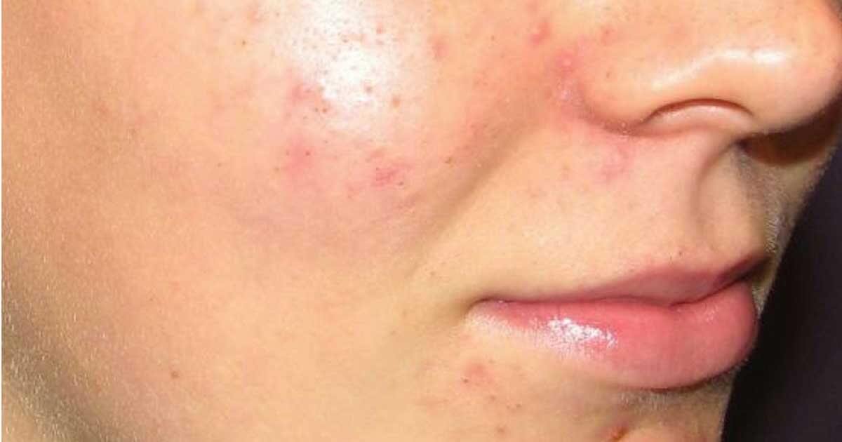 Are You Looking on How to Get Rid of Acne