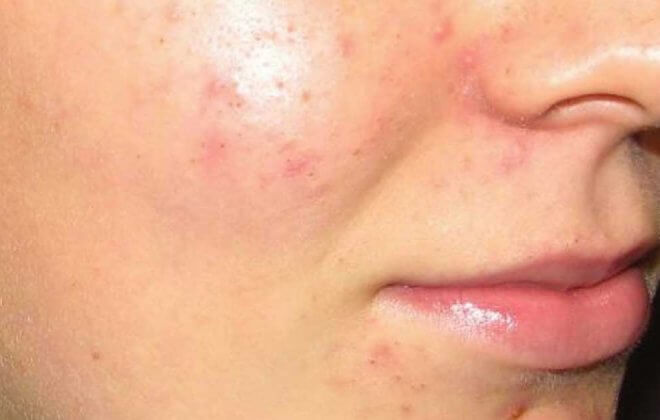 Are You Looking on How to Get Rid of Acne
