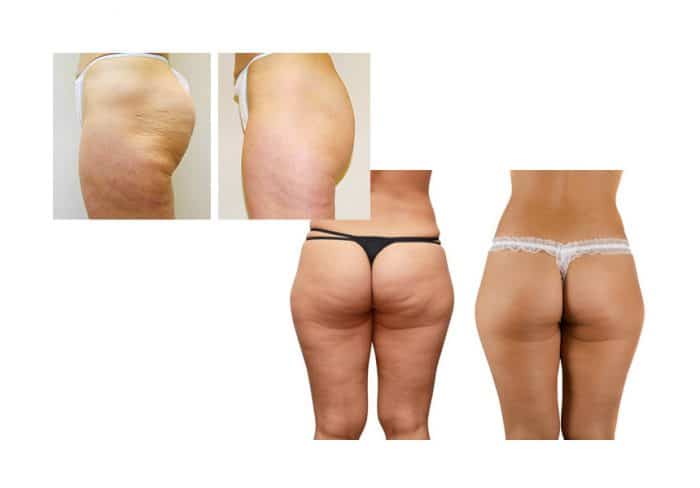 Fat freezing cryolipolysis lipo Belrose cool sculpting cavitation laser liposuction