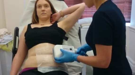 Fat freezing lipo cryolipolysis Palm Beach cool sculpting cavitation laser liposuction