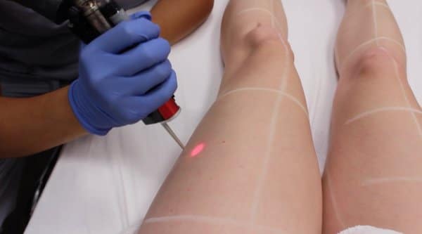 IPL laser hair pigmentation removal St Leonards red vein stretch mark freckle