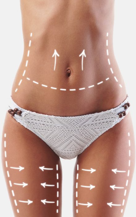 Fat freezing cryolipolysis lipo Mona Vale cool sculpting cavitation laser liposuction