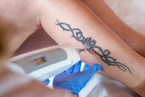 Great blogs for skincare and beauty Xara Skin Clinic #1 Tattoo Removal Process What is the process of getting your tattoo removed?