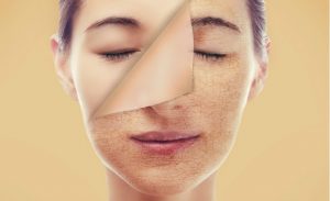 Dry Skin Care - Best Treatments for Dry Skin - Xara Skin Clinic Sydney