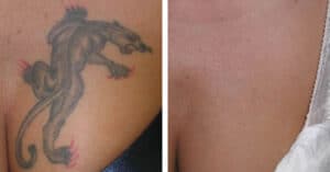 Laser tattoo removal treatment after care what’s involved?