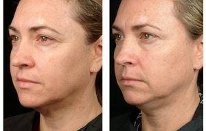 Anti aging wrinkle remove face lift Rose Bay #1 Thermagie skin tightening