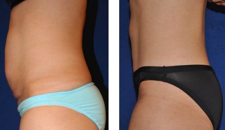 Fat removal freezing Sydney #1 price safe best effect result