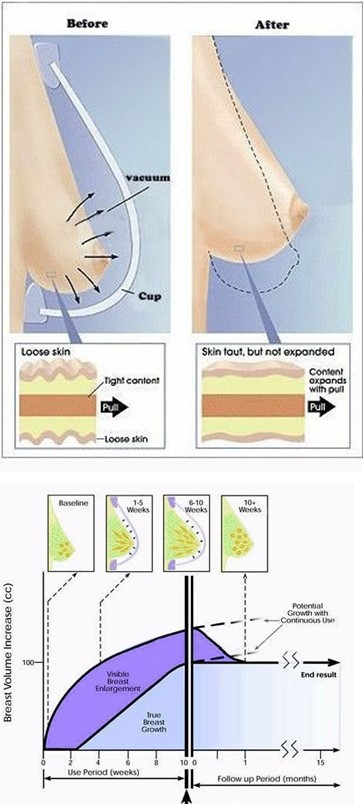 Non invasive breast lift enhance Sydney butt enlargement