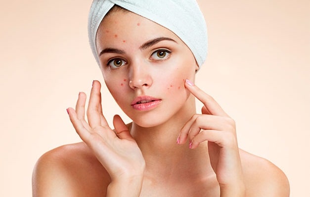 Acne scar removal facial peels Mona Vale #1 light therapy oxygen Botulinum and dermal fillers