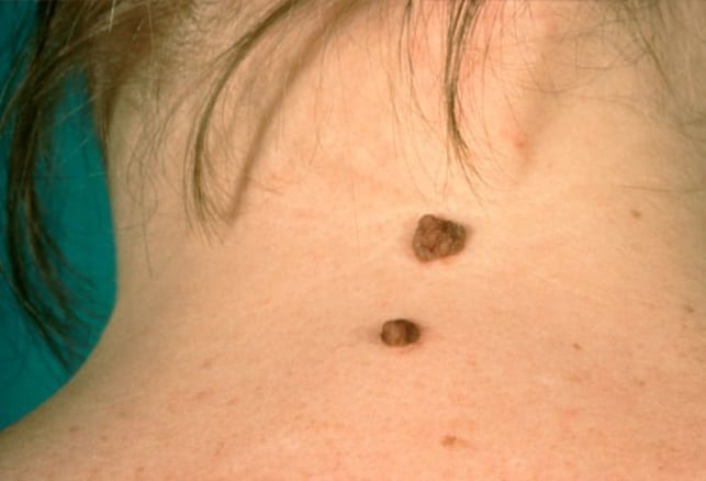 Mole cellulite scar fat removal Paddington body shaping loose skin tag milia