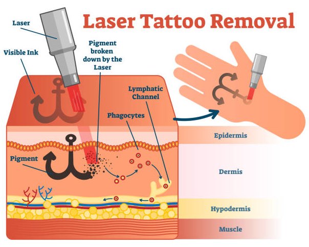 EMS clinic tattoo removal facial Mona Vale body shaping beauty salon