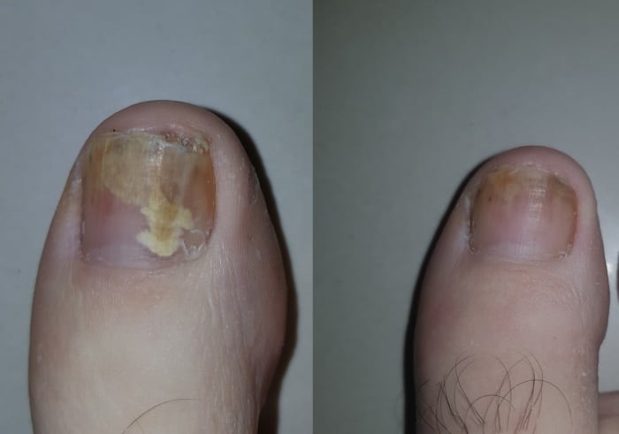 Fungal toe finger nail removal onychomycosis treatment Sydney