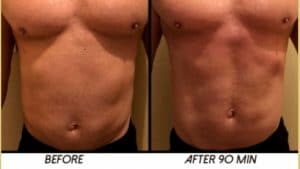 HiFu fat removal skin tightening Sydney #1 best treatment 3D HIFU deals fat removal before and after Sydney 300x169