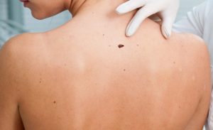 Safe effective get rid mole wart blemish skin tag growth removal Sydney
