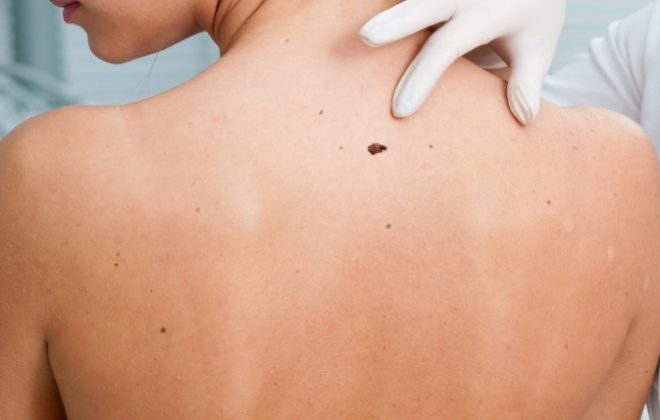Safe effective mole wart blemish skin tag removal Sydney