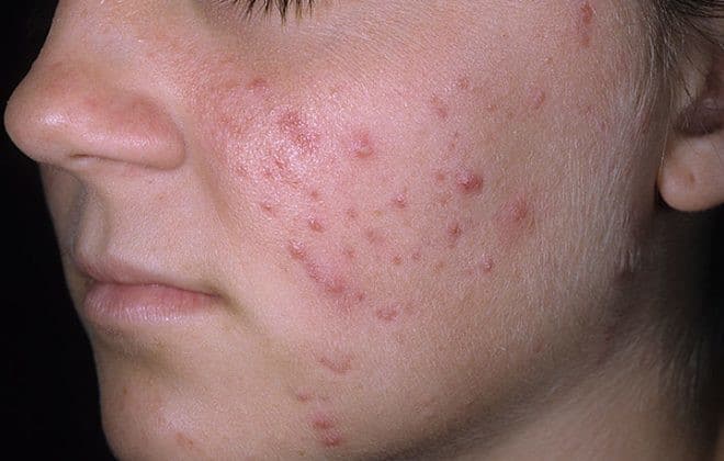 Active acne scarring treatment removal Sydney #1 painless