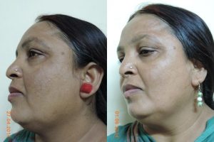 Skin lightening whittening acne black age live spot removal cream