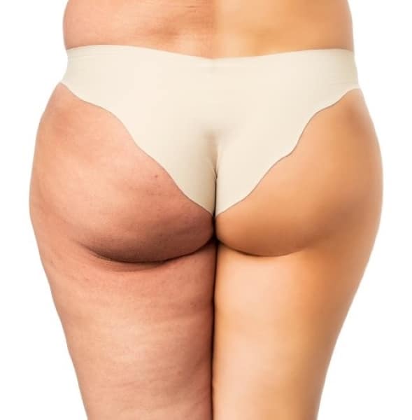 Cryolipolysis fat freezing removal Sydney non invasive surgical