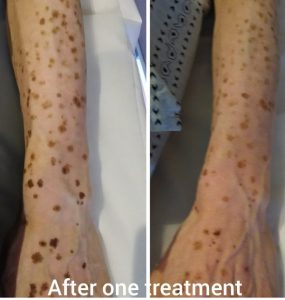 Sun age liver spots pigmentation Sydney removal before after