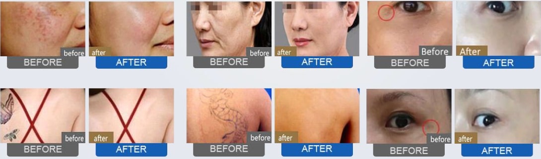 Best Picosecond laser Sydney