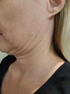 1 fantastic HIFU double chin wrinkle removal treatment Sydney