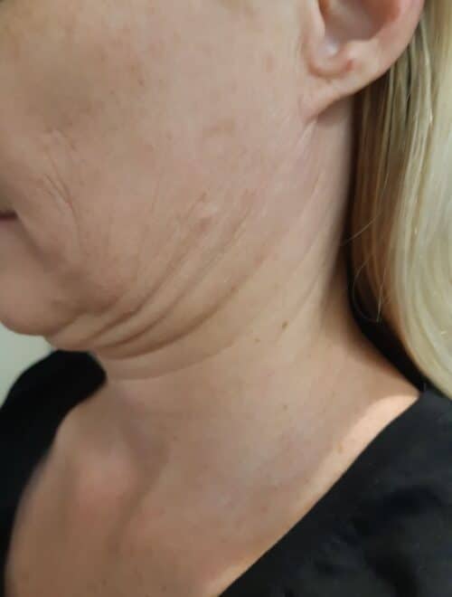 HIFU double chin removal treatment Sydney #1 skin tightening