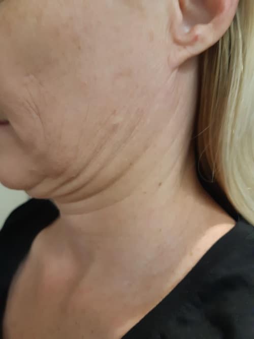 HIFU double chin removal treatment Sydney #1 skin tightening