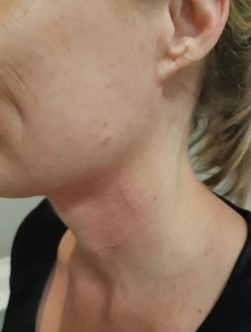 HIFU skin tightening before and after pictures in Sydney
